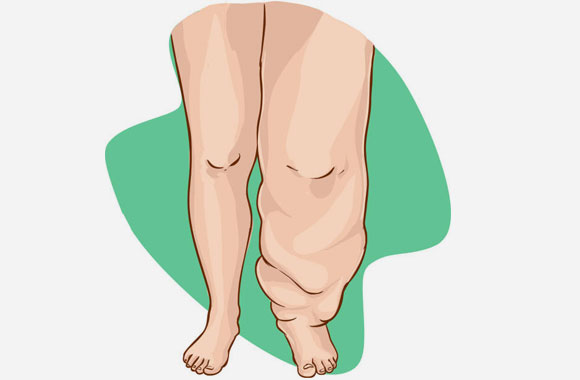 Lipödem mi Kilo Problemi mi? Kalın Bacak ve Basende 5 Ayırt Edici İşaret